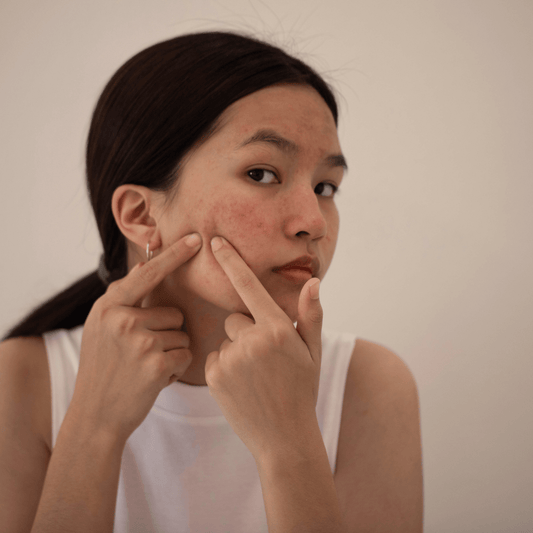 Can Acne Be Permanently Removed? Understanding the Path to Clear Skin - Mono Skincare