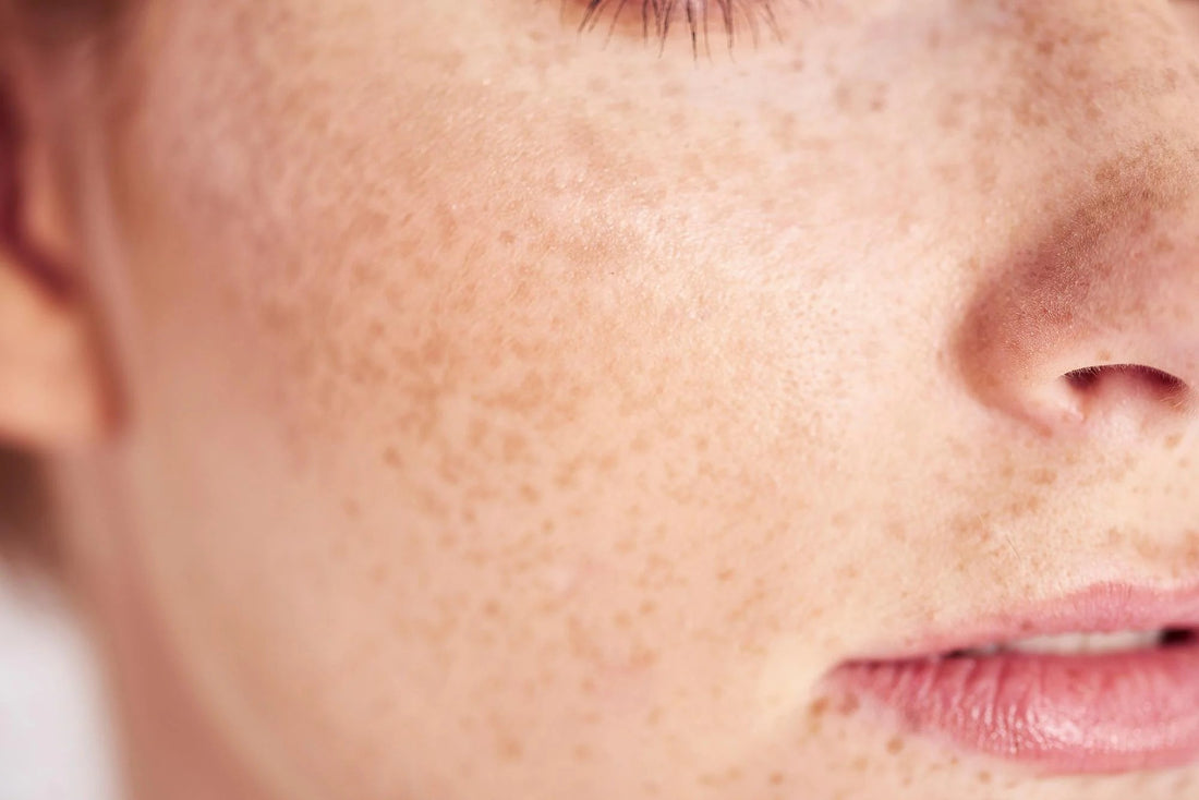 "La sensation d'une peau qui tiraille.." Que faire? - Mono Skincare
