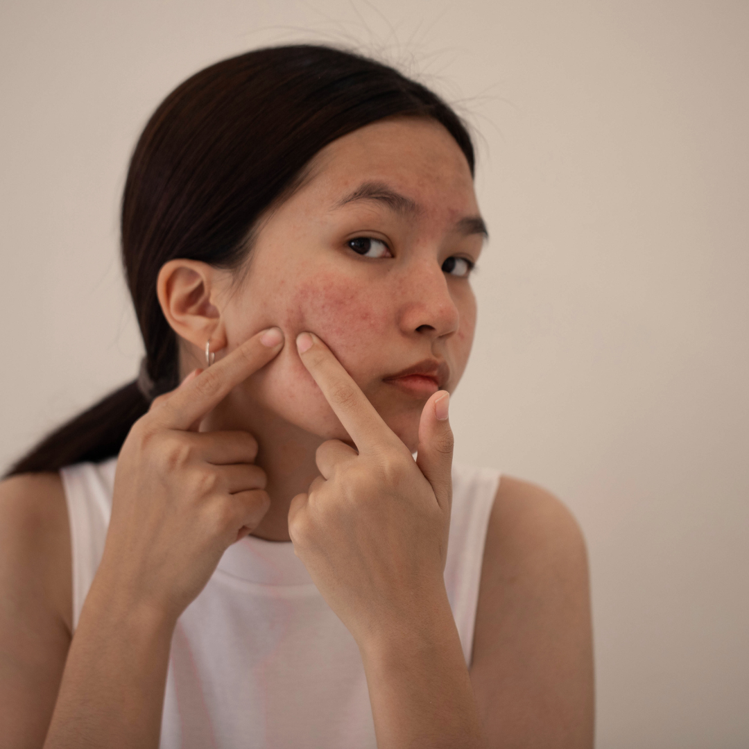 Woman applying skincare products as part of an effective acne treatment routine