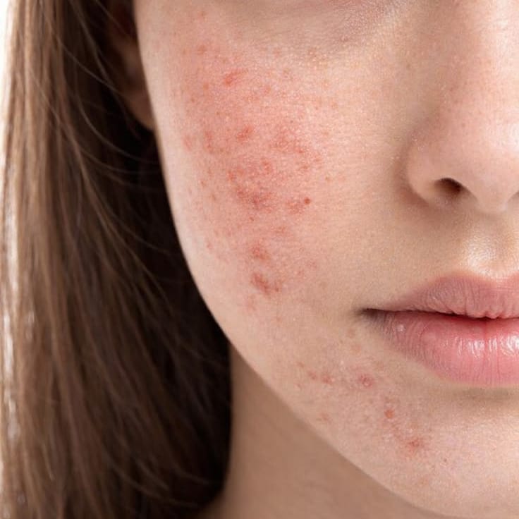 Close-up of a person's face with acne on a neutral background